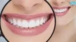 تمام آنچه که باید درباره لیفت لثه بدانید