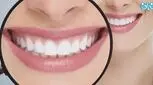 تمام آنچه که باید درباره لیفت لثه بدانید