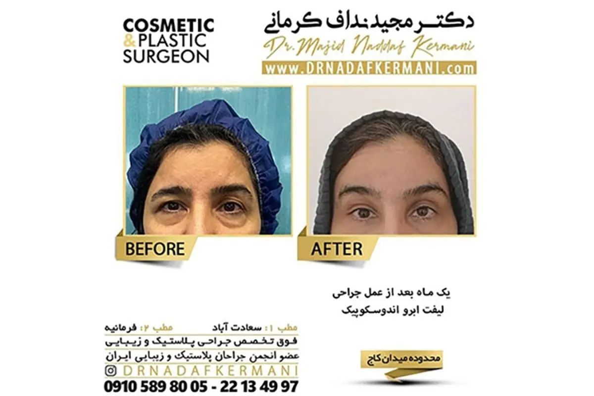 روش های لیفت ابرو،بهترین روش کدام است؟