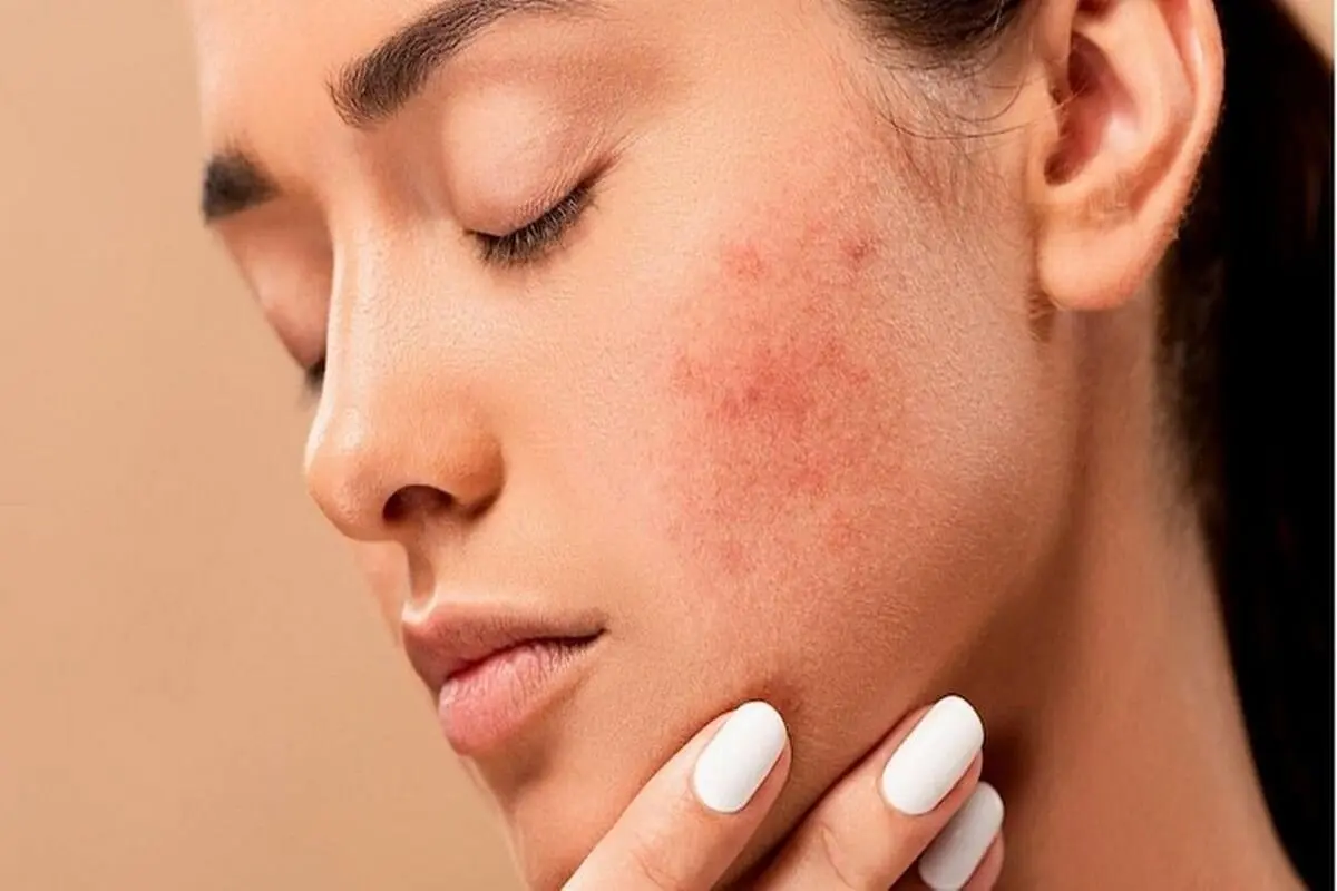 خلاص شدن از شر جوش های پوستی برای همیشه