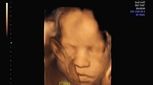 سونوگرافی تخصصی سه بعدی برای جنین