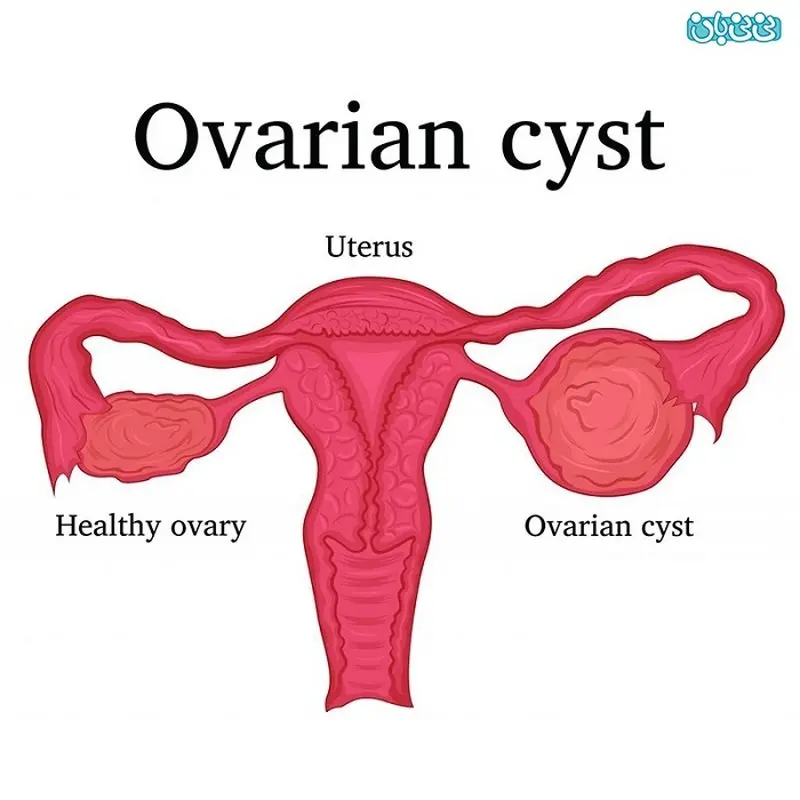 آیا کیست ها مانع بارداری می شوند؟