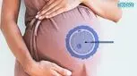 استفاده از لیزر در IVF، کمک به لانه‌گزینی جنین