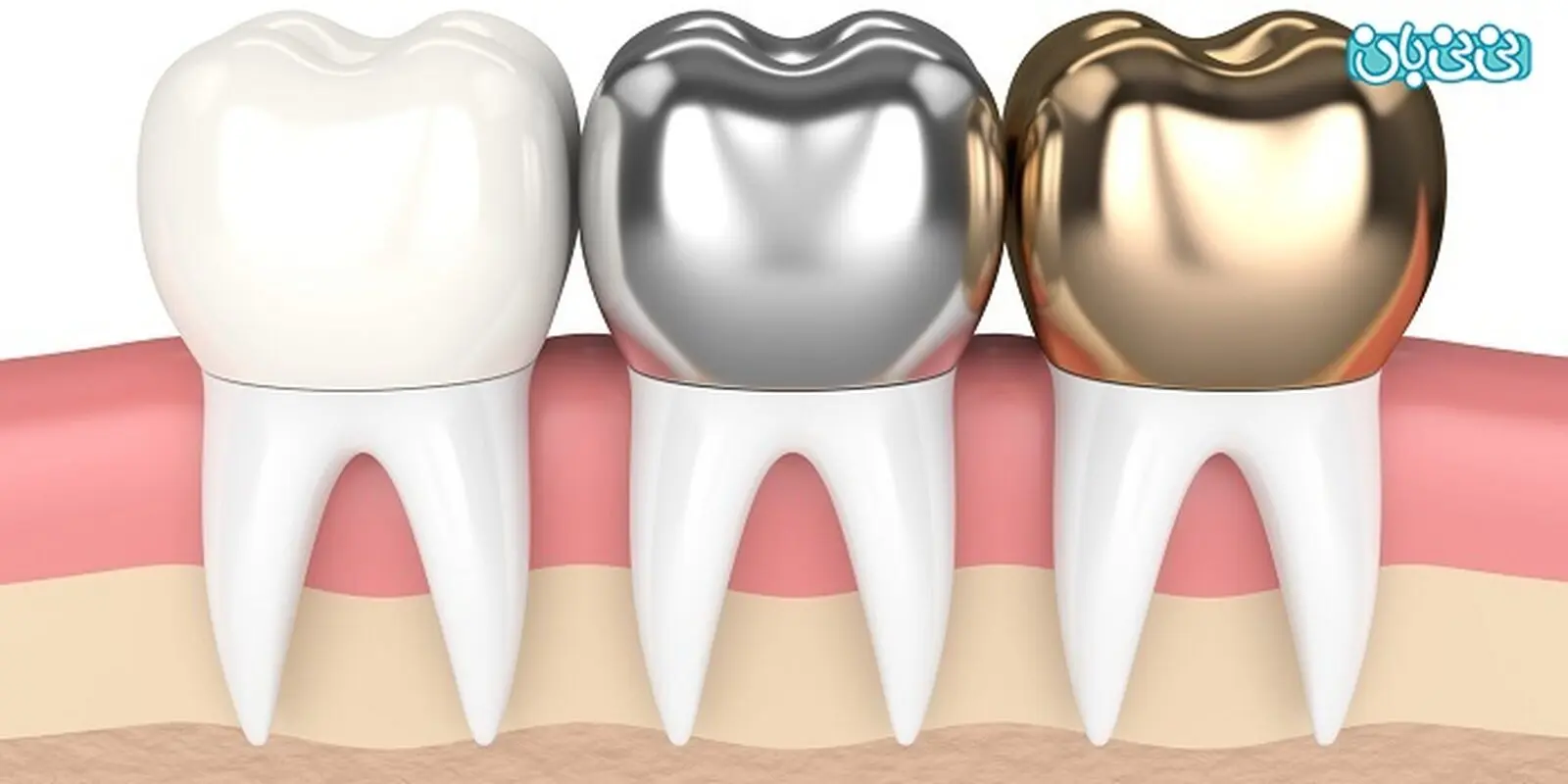 بهترین روکش دندان چیست؟ مزایا و معایب 5 نوع رایج و بادوام