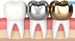بهترین روکش دندان چیست؟ مزایا و معایب 5 نوع رایج و بادوام