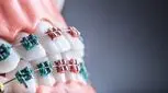 براکت ارتودنسی چیست و چگونه کار می کند؟