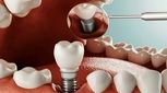 عوارض ایمپلنت دندان چیست؟ آیا کاشت دندان خطری دارد؟