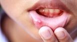 آفت دهان چیست؟ درمان دارویی و خانگی آفت دهان