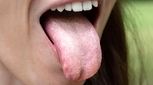 علت برفک دهان در بزرگسالان چیست؟ علائم و درمان