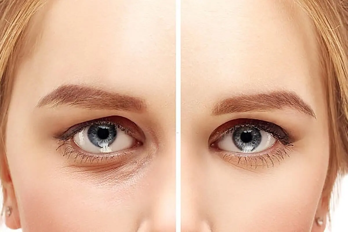 خداحافظی با چروک دور چشم/ راهکارهای مقابله با چروک دور چشم بدون بوتاکس