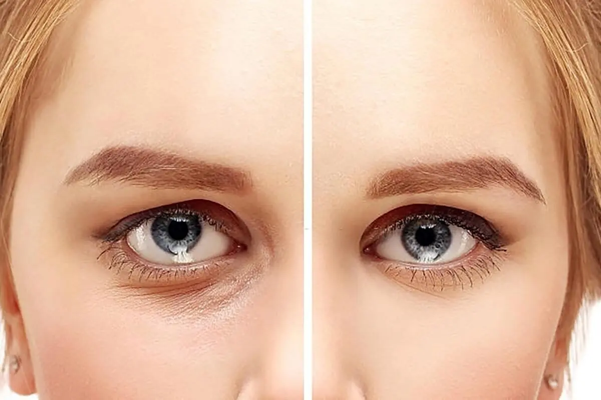 خداحافظی با چروک دور چشم/ راهکارهای مقابله با چروک دور چشم بدون بوتاکس