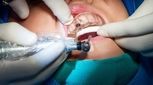 راهنمای کاشت ایمپلنت دیجیتال: مراحل و فنون گاید جراحی
