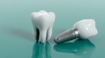 چطور بدون جراحی دندان های خود را ایمپلنت کنیم؟