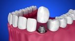 جراحی ایمپلنت دیجیتال و مزیت کاشت دندان دیجیتال