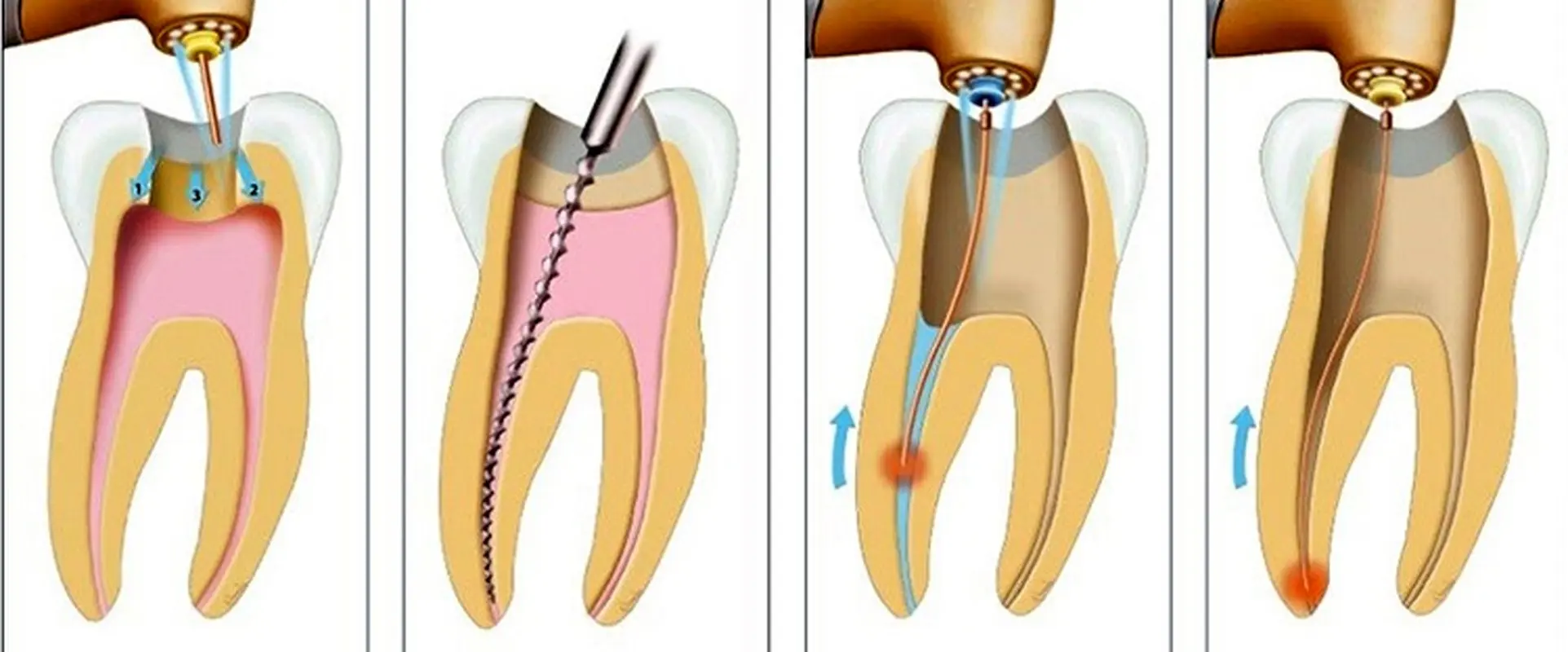 کاربرد لیزر در دندانپزشکی نوین