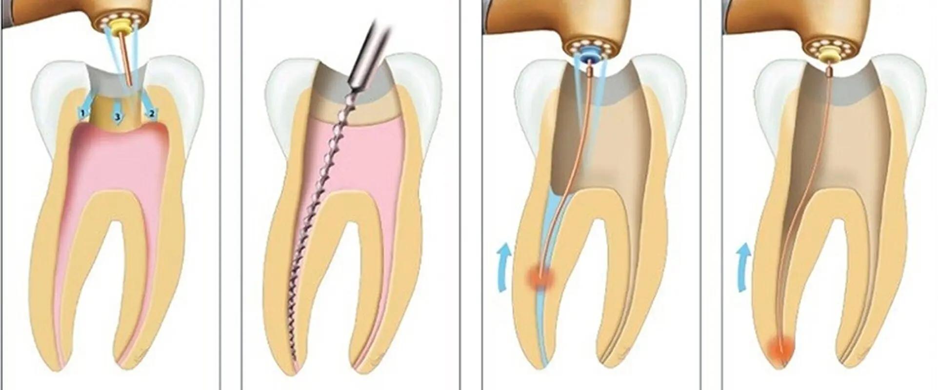 کاربرد لیزر در دندانپزشکی نوین