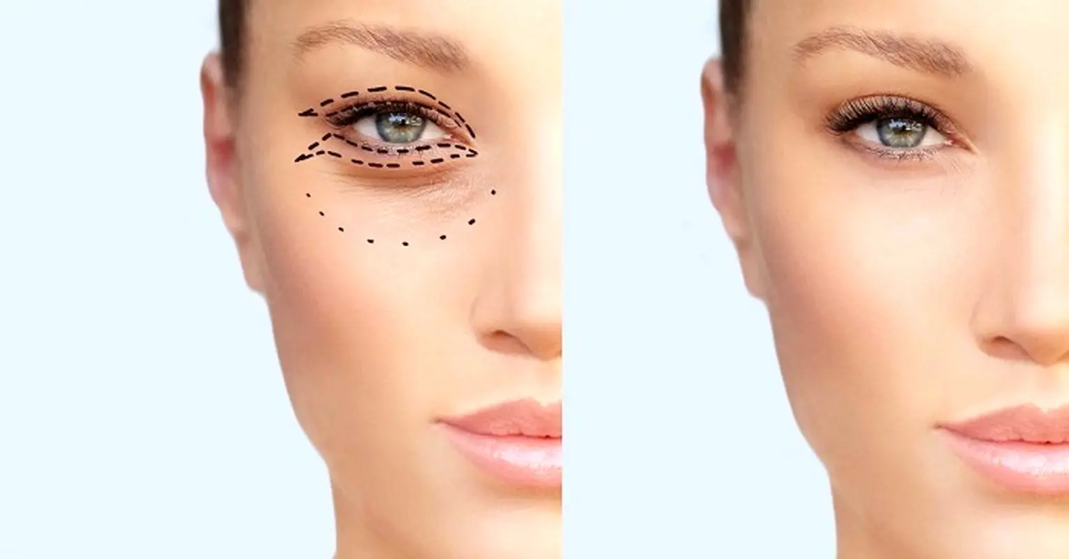 مراقبتهای بعد از جراحی بلفاروپلاستی