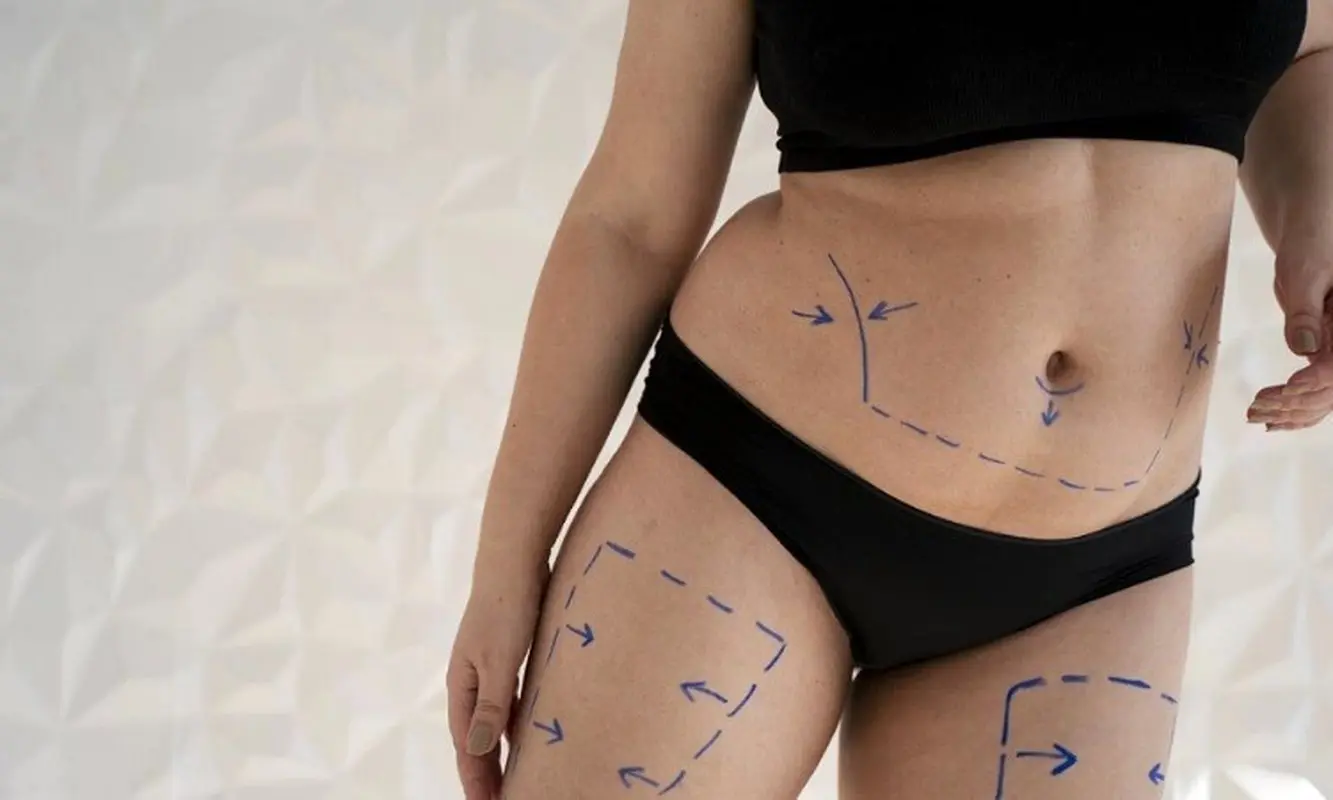 هزینه لیپوماتیک شکم و پهلو