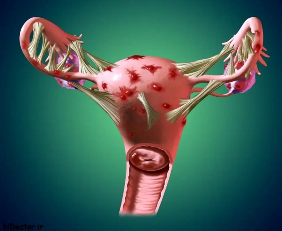 آیا آندومتریوز باعث ناباروری می شود؟