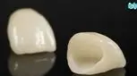 تعویض روکش دندان چگونه انجام می‌شود؟ هدف و مراحل