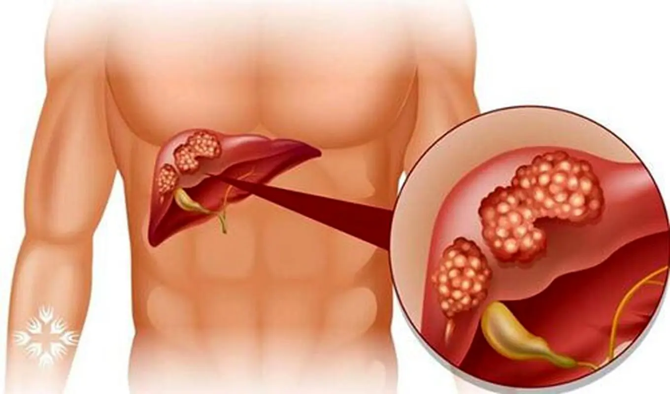 درد کیسه صفرا کجاست؟ راه‌ های شناخت و درمان آن