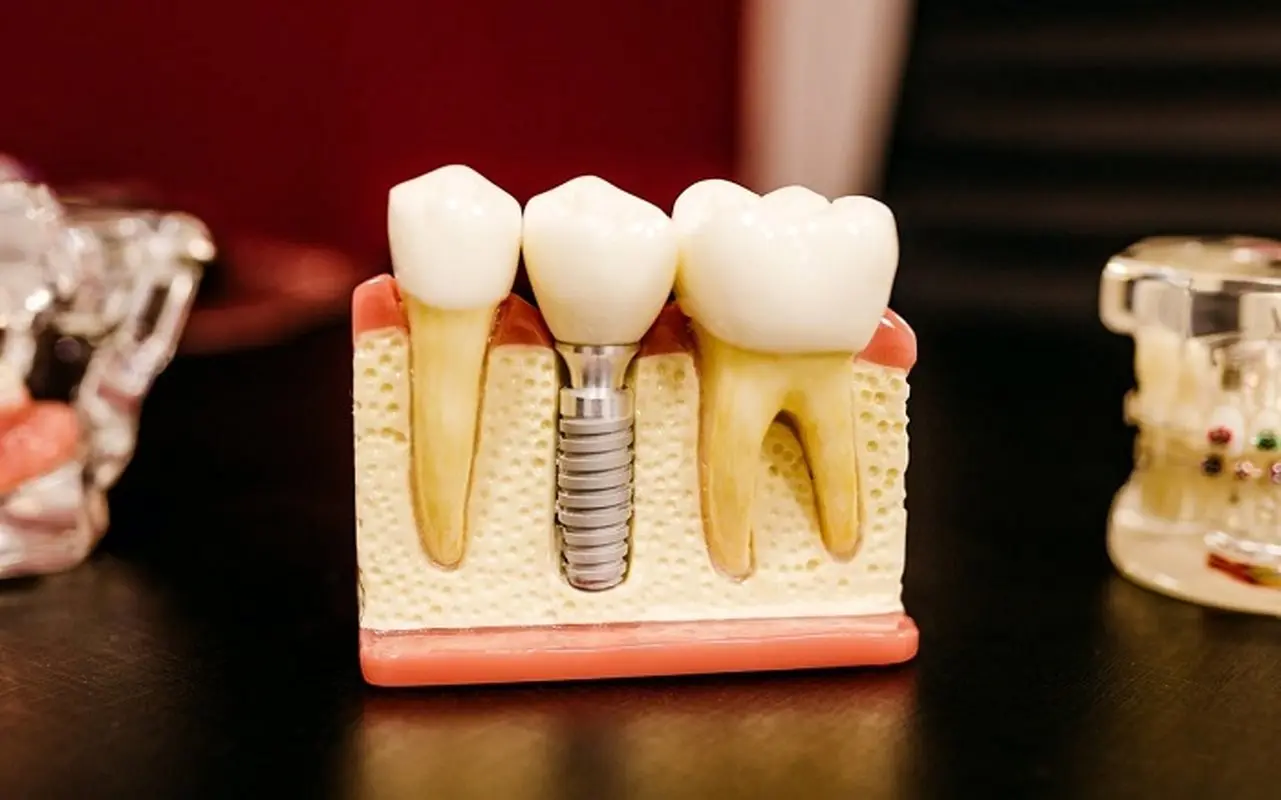 اول ارتودنسی یا ایمپلنت؛ کدام را زودتر انجام دهیم؟