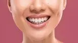 هزینه اصلاح طرح لبخند چقدر است؟