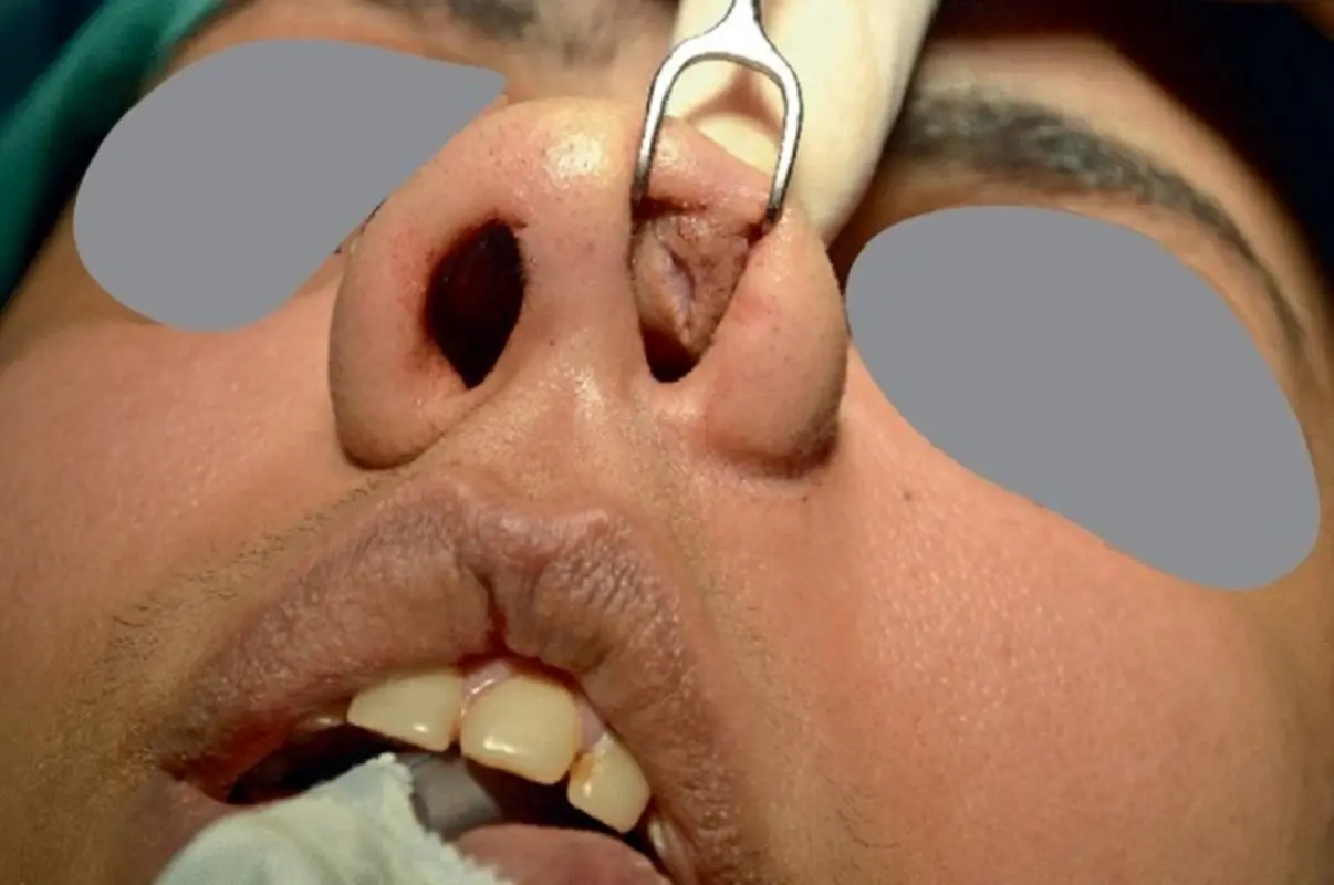 عفونت بعد از عمل بینی و راه های جلوگیری از عفونت بعد از جراحی بینی