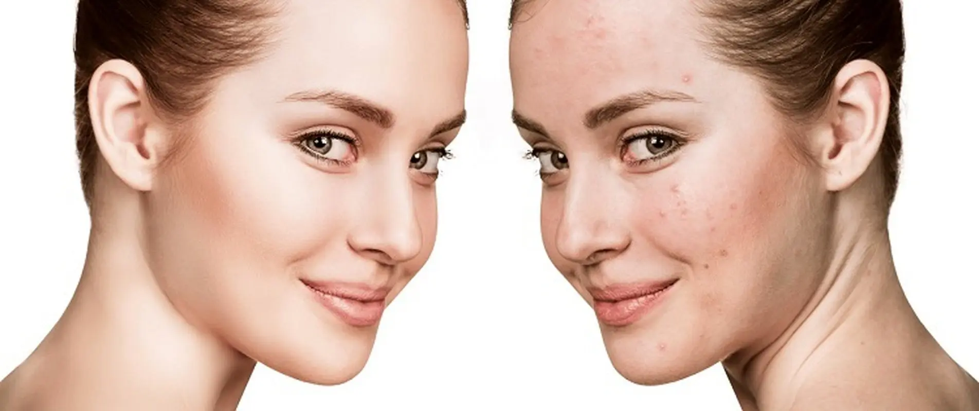 درمان جوش های هورمونی چگونه است؟