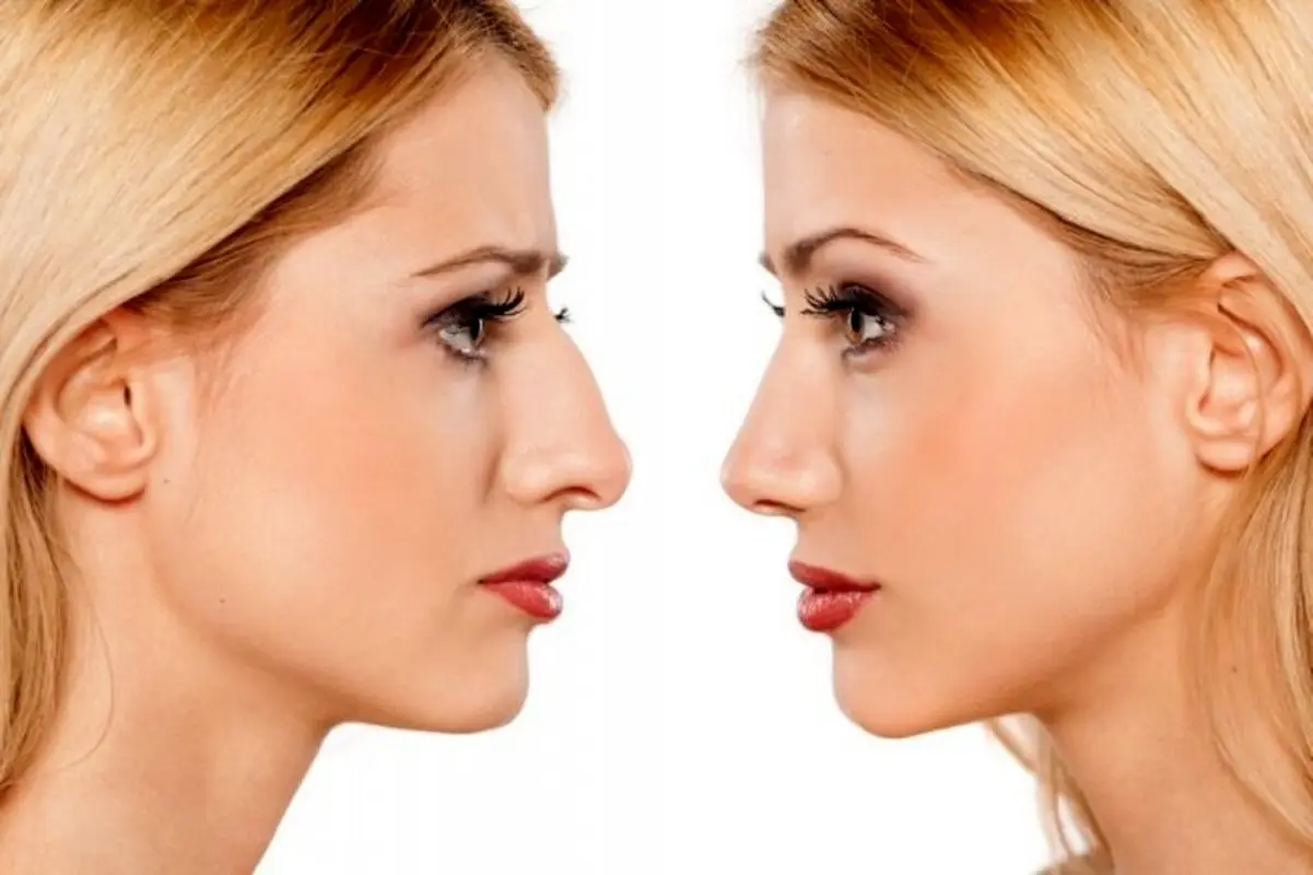 مزایا و معایب جراحی نوک بینی (تیپ پلاستی) چیست؟