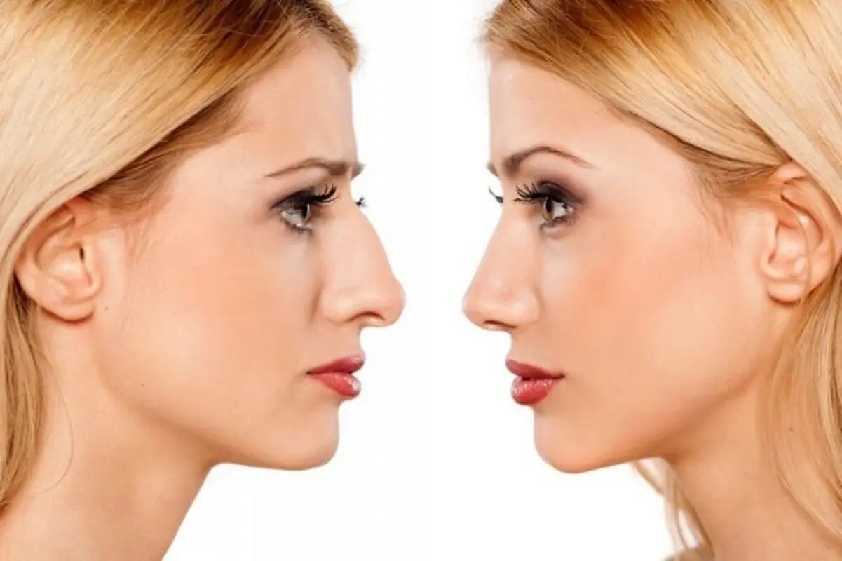 مزایا و معایب جراحی نوک بینی (تیپ پلاستی) چیست؟