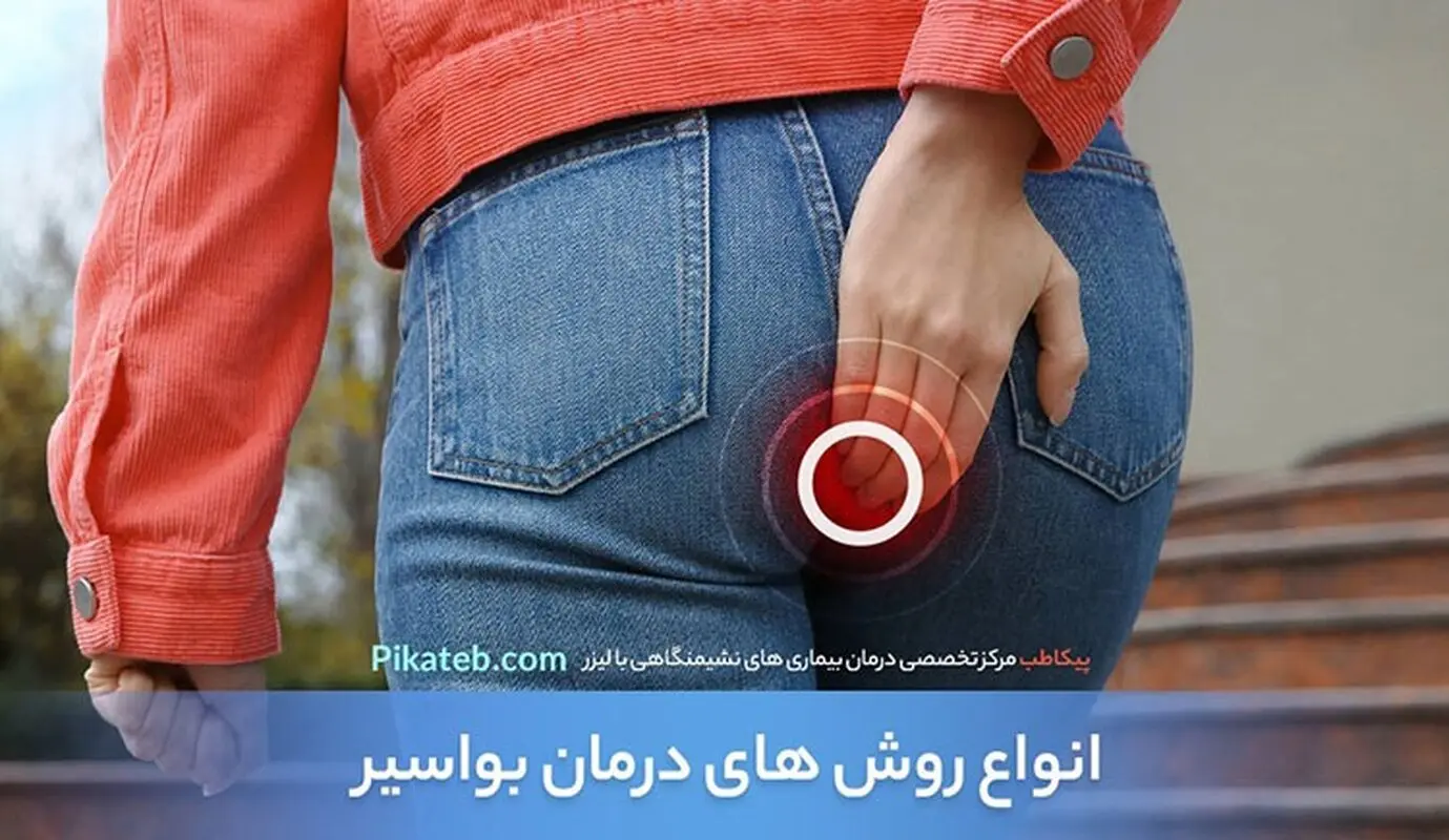 انواع روشهای درمان بواسیر یا هموروئید