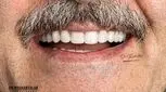کاشت ایمپلنت دندان | ایمپلنت ۳ دقیقه‌ای