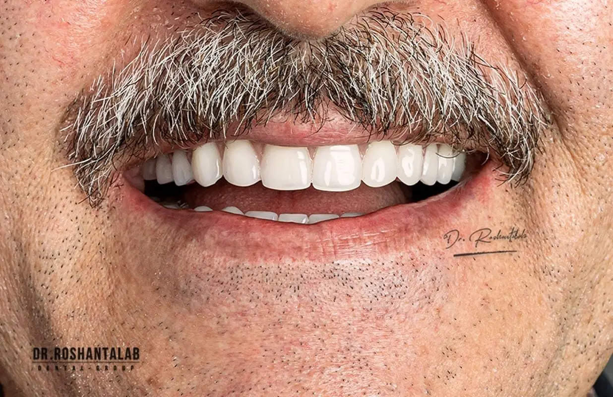 کاشت ایمپلنت دندان | ایمپلنت ۳ دقیقه‌ای