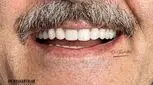 کاشت ایمپلنت دندان | ایمپلنت ۳ دقیقه‌ای