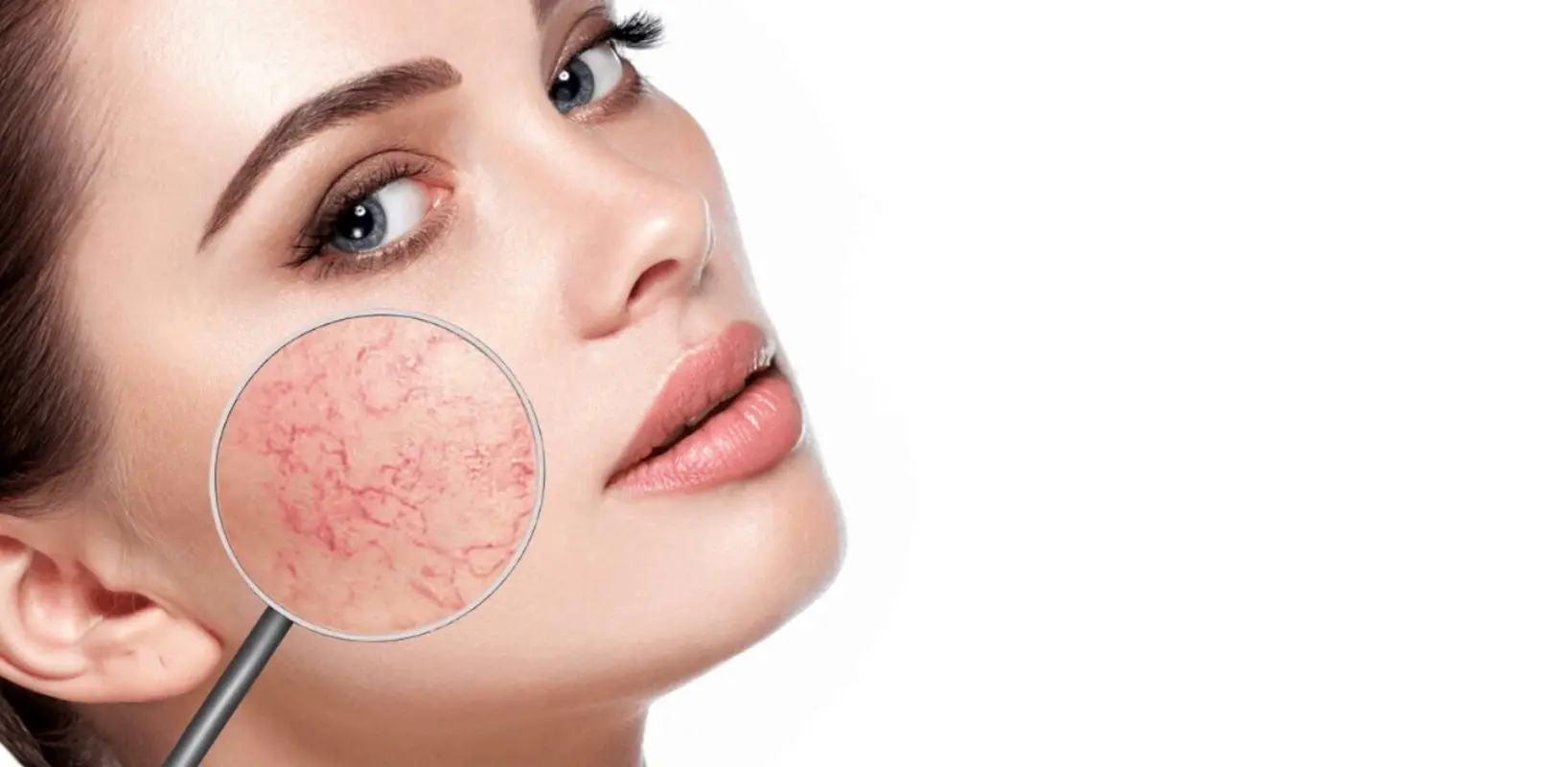 واریس صورت چیست و چگونه آن را درمان کنیم؟