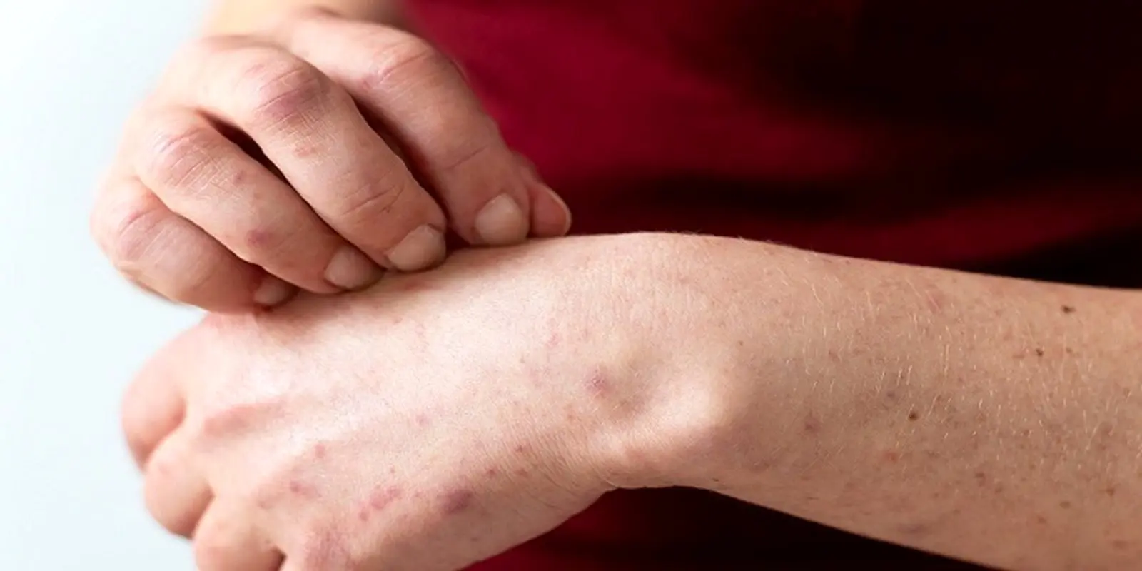 درمان آلرژی و حساسیت به لاتکس چیست؟ علائم آلرژی به لاتکس