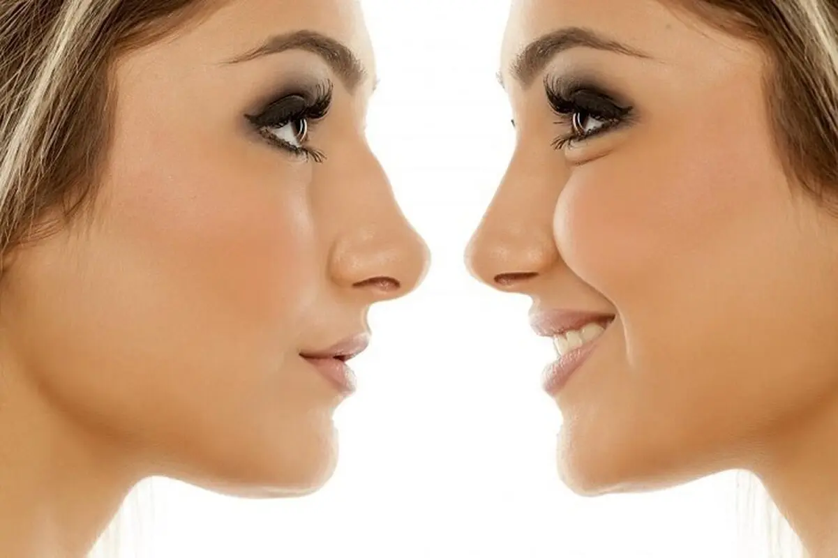 عمل بینی نچرال چیست و چگونه انجام می‌شود؟