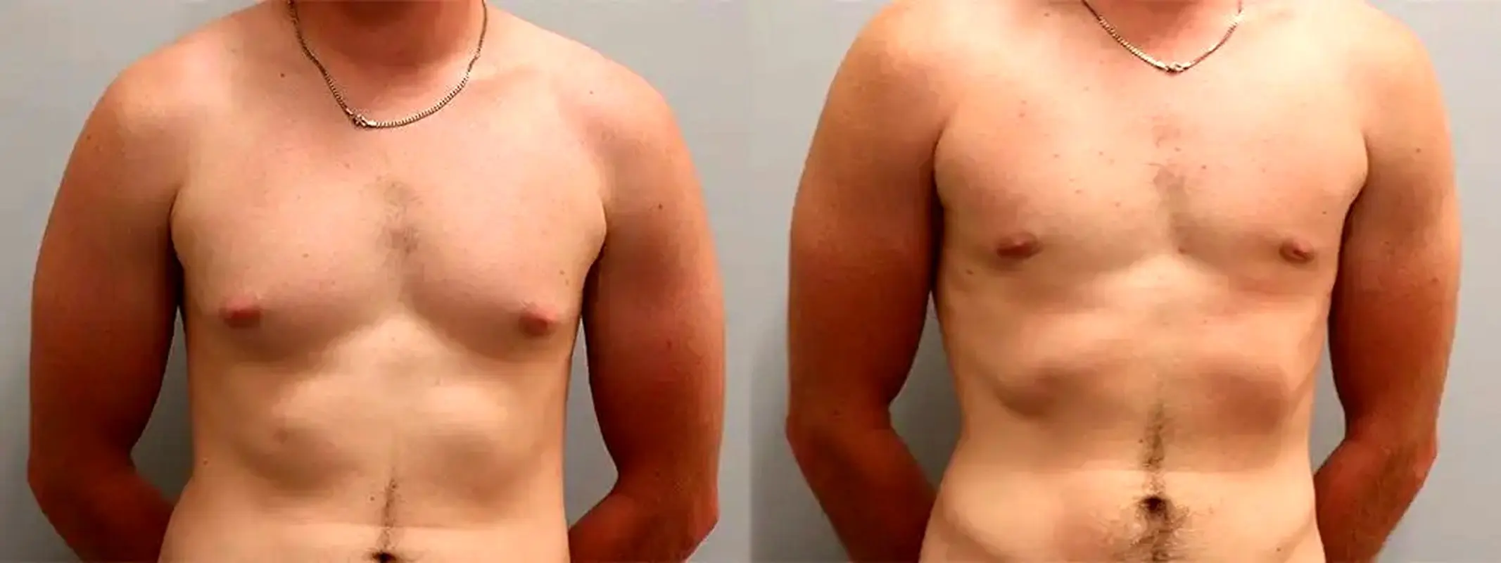 نکات مراقبتی بعد از ژنیکوماستی که باید بدانید