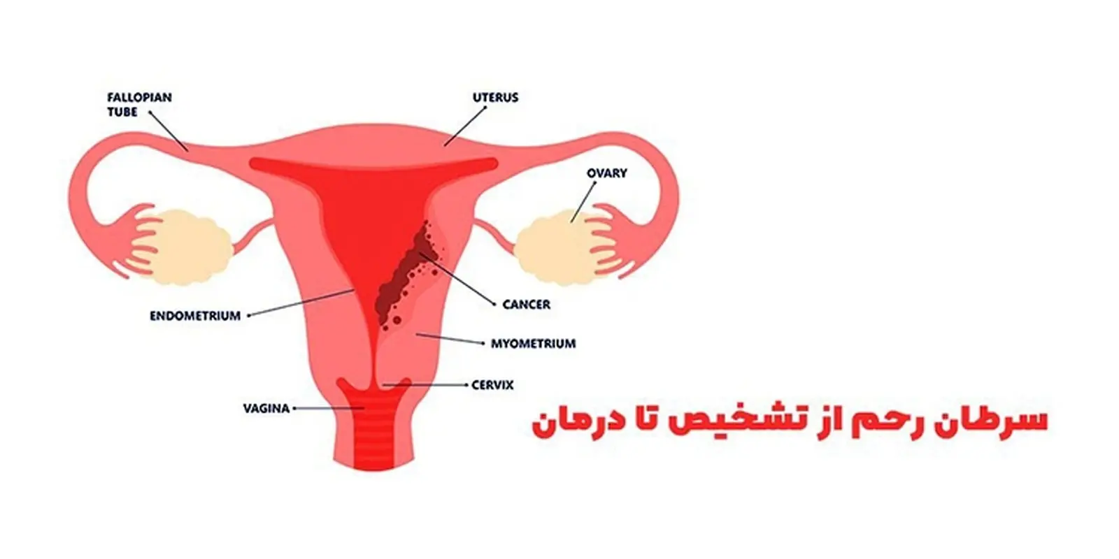 سرطان رحم از تشخیص تا درمان