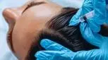 هزینه مزوتراپی مو در سال 1404 چقدر است؟