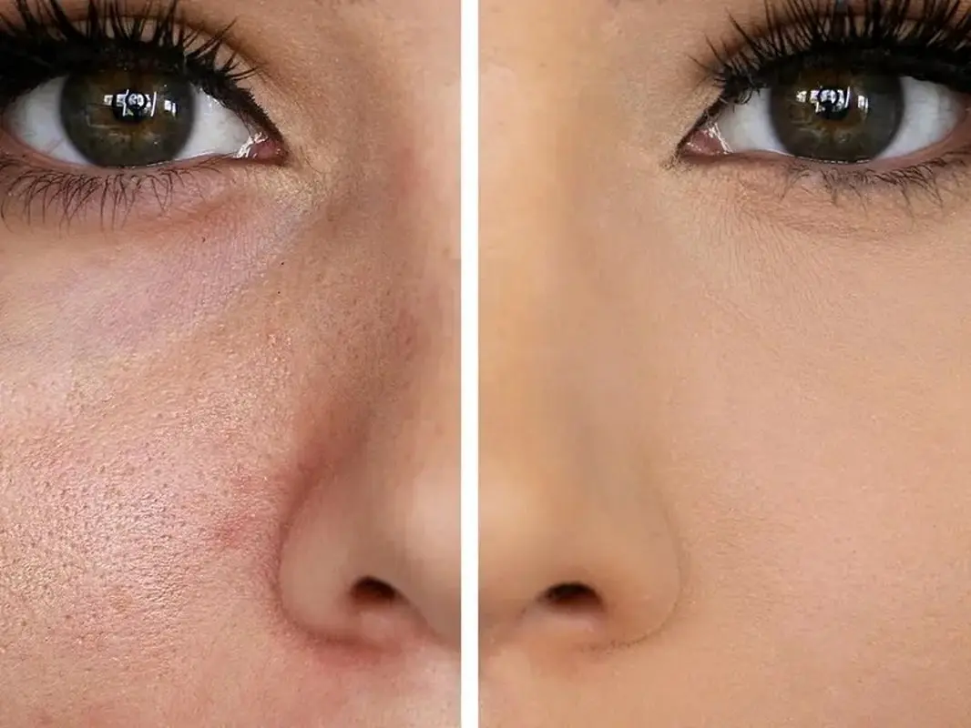 با این راهکارهای ساده و خانگی مشکل منافذ باز پوست را برای همیشه حل کنید