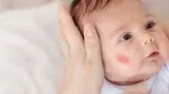 واریس صورت در کودکان چیست؟ علت و درمان