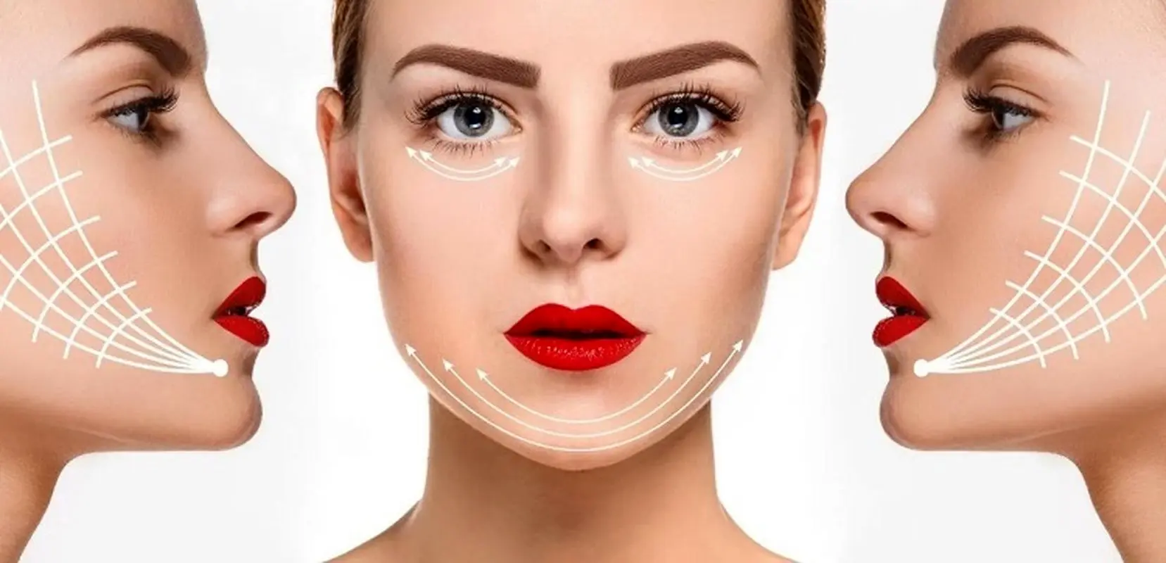 آشنایی با عوارض لیفت شقیقه با نخ؛ خطرناک ترین عوارض لیفت شقیقه با نخ