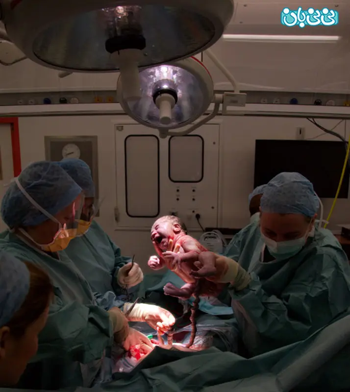 سزارین، عملی مدرن یا جراحی پر درد