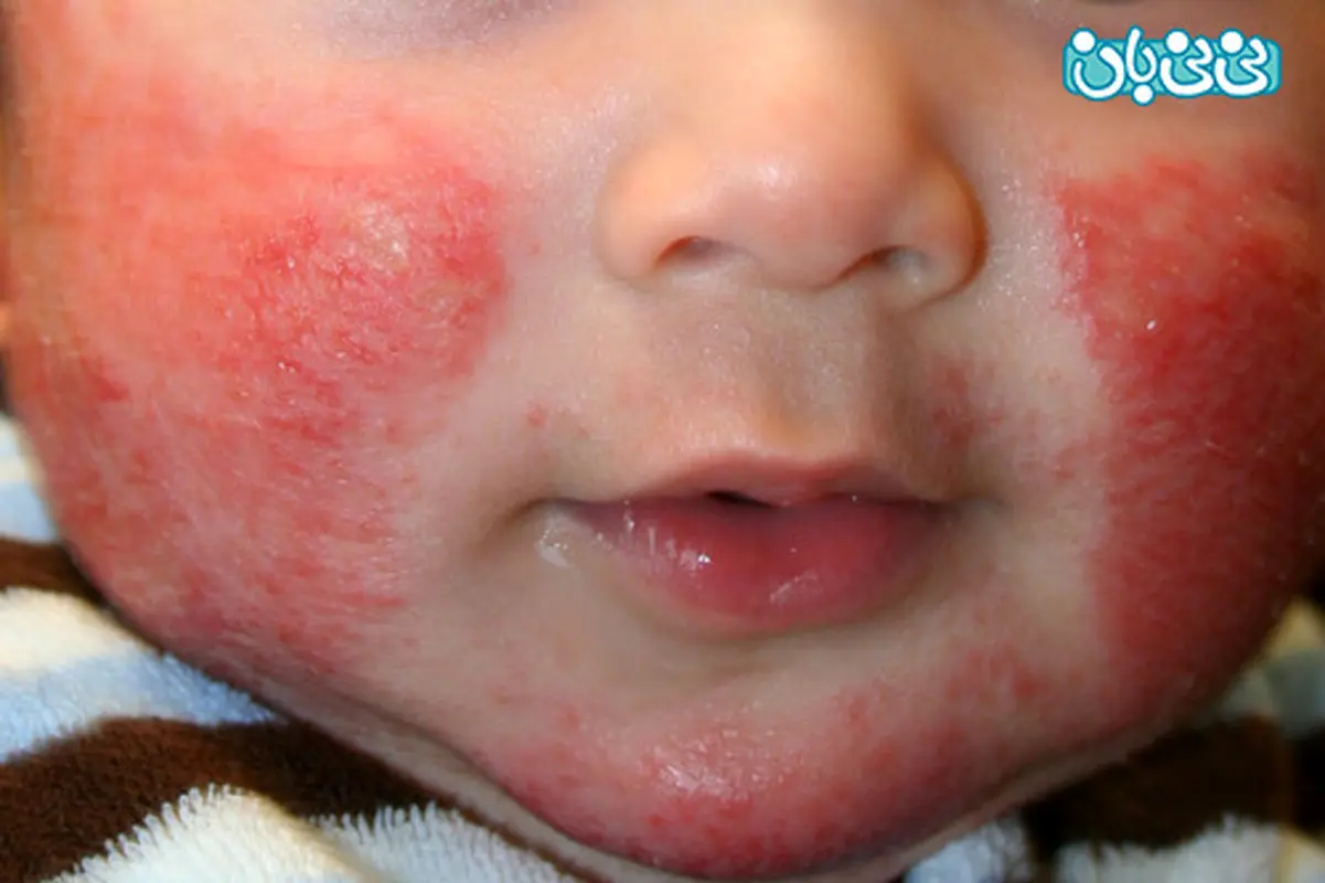 اگزما صورت کودکان، شایع است؟