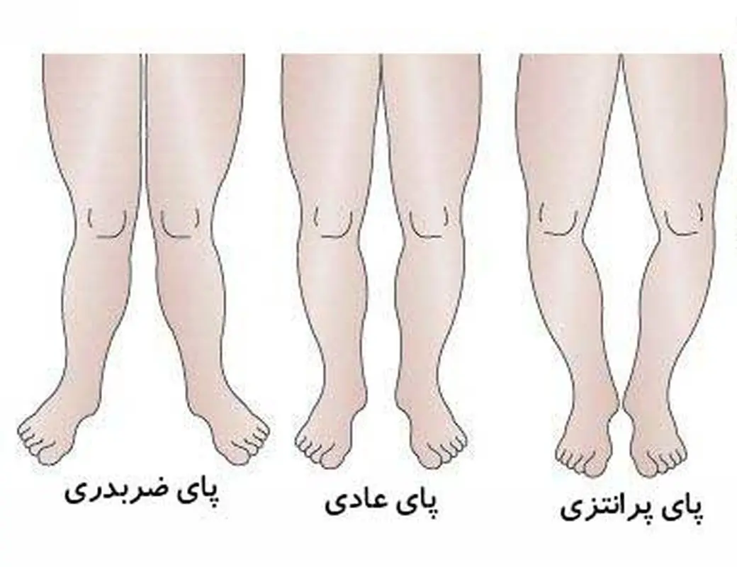 انواع مشکلات پا در کودکان، حرکت‌های اصلاحی