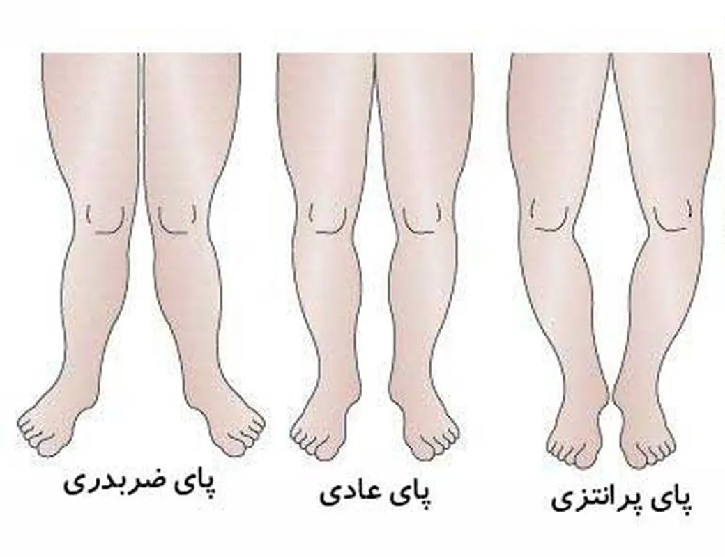 انواع مشکلات پا در کودکان، حرکت‌های اصلاحی