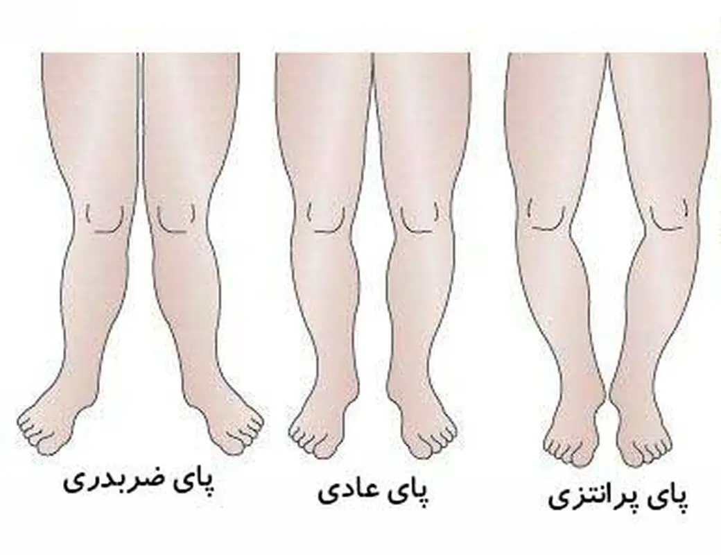 انواع مشکلات پا در کودکان، حرکت‌های اصلاحی