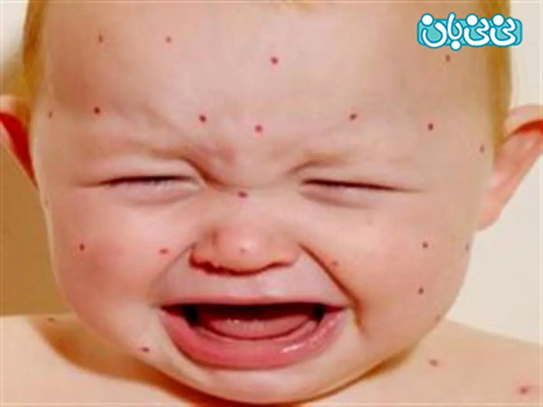 آبله مرغان در کودکان و نوزاد